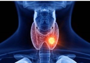 ضرورت بررسی فوری عوامل محیطی مؤثر بر افزایش موارد سرطان تیروئید در شهرستان ورزقان