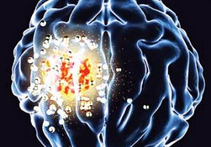 نابودی تومورهای مغزی با یک دستگاه بی‌سیم